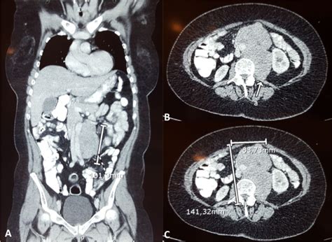 Resection of retroperitoneal soft-tissue sarcoma involving the ...