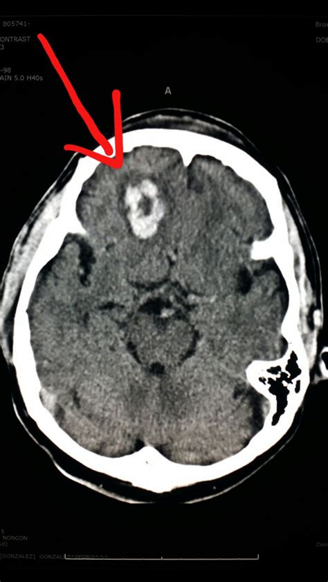 Spect Ct Scan Brain Ct Scan Machine