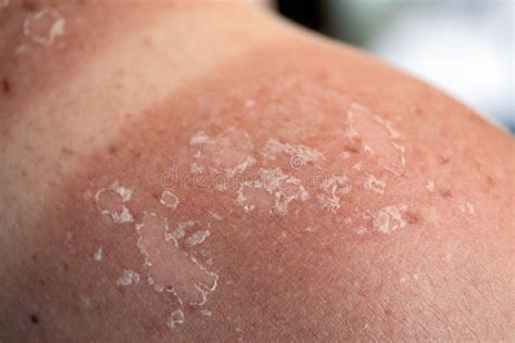 Peeling Skin at Back and Shoulder from Sunburn Effect Stock Image - Image of melanoma, beach ...