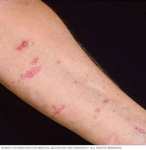 Lichen planus - Mayo Clinic