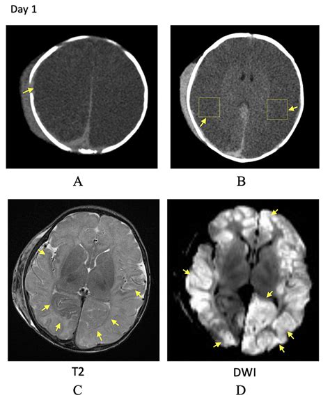 Big Black Brain Phenomenon: Understanding Clinicoradiological ...