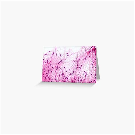 "Astrocytoma Histology" Greeting Card by deltoid | Redbubble