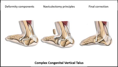 Naviculectomy as a Third Way Beyond Minimally Invasive and Extensive Soft Tissue Releases for ...