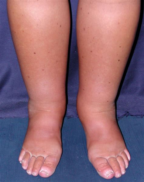 What is Lymphedema? | The Cancer Help Blog