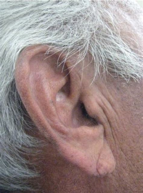 Frank's Sign (Diagonal Earlobe Crease) | Stanford Medicine 25 | Stanford Medicine