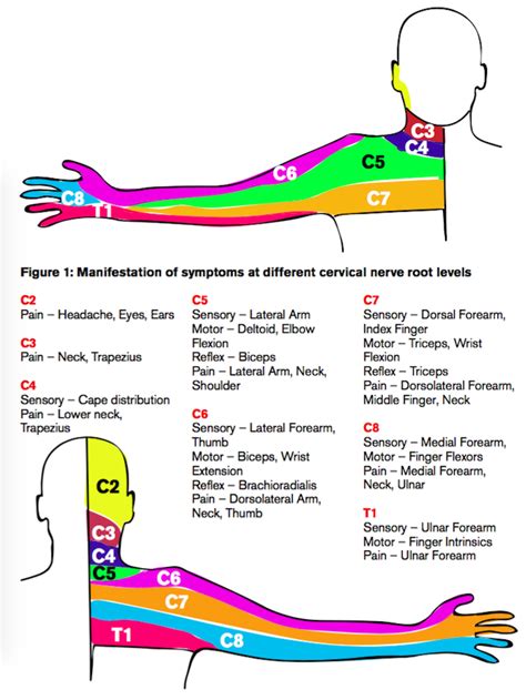 Radicular Syndrome Of The Cervical Spine Symptoms Treatment | Images ...