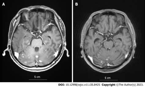 Abemaciclib-induced lung damage leading to discontinuation in brain metastases from breast ...