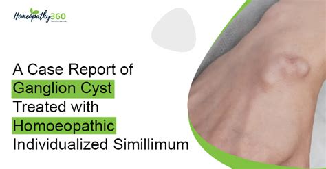 What Are The Homeopathic Remedies For Ganglion Cysts?, 59% OFF