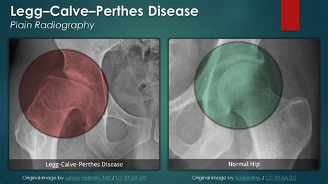 Legg-Calve-Perthes Disease: Plain Radiography - YouTube