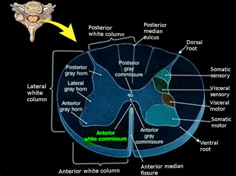 [Figure, Anterior white commissure Image courtesy O.Chaigasame ...