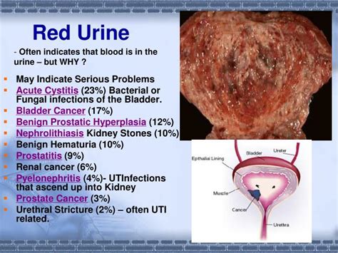 Causes Of Blood In Urine Peeing Blood Thrombocytes | My XXX Hot Girl