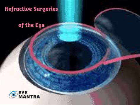 Refractive Surgery | Refractive Errors & Types of Treatment | EyeMantra