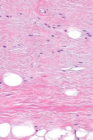 Spindle cell lipoma - Libre Pathology