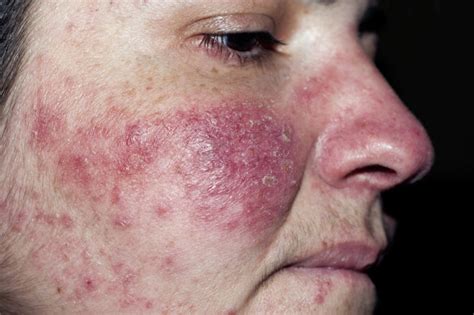 Patch Testing Beneficial in Rosacea to Detect Contact Sensitivity - Dermatology Advisor