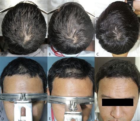 Minoxidil Before And After: Photos & Results | Wimpole Clinic