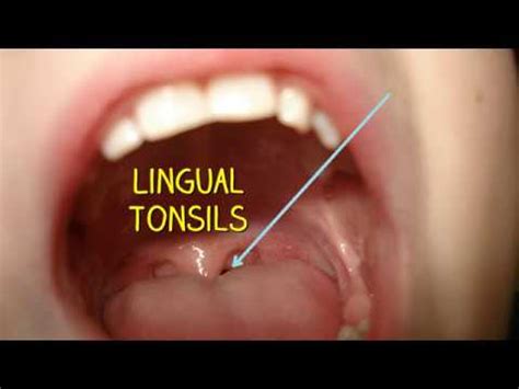 Lingual Tonsils