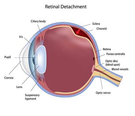 Retinal Surgery Asheville | Retinal Detachment Hendersonville