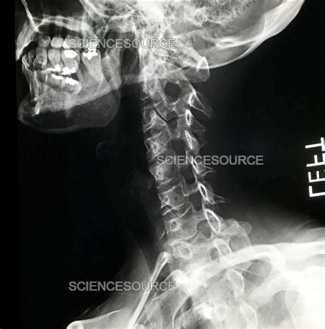 Normal Cervical Spine, X-Ray | Stock Image - Science Source Images