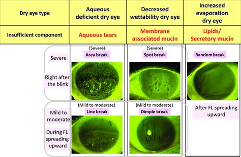 Tear Film Oriented Diagnosis (TFOD) -the fluorescein breakup patterns... | Download Scientific ...