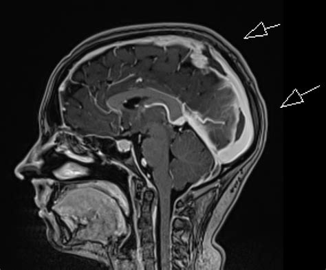 Radiology MRI: Intracranial Hypotension with Dural Sinus Thrombosis