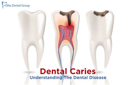 DENTAL CARIES- CAUSES, SYMPTOMS, TYPES AND TREATMENT | by Elite Dental Group | Medium