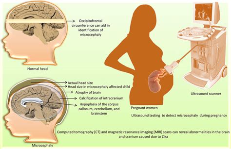 | Diagnosis of microcephaly caused by Zika virus. | Download Scientific Diagram