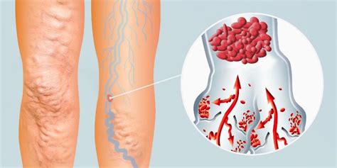 ¿Qué es la flebitis? Tipos y tratamiento