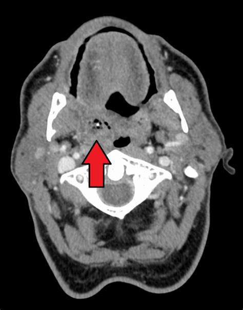 Peritonsillar abscess - WikEM