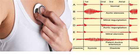 Heart Murmurs: Signs and Symptoms | Things Health