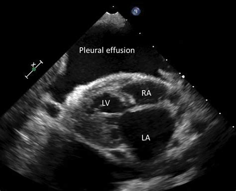 pleural effusion cat heart failure - Krishna Strand