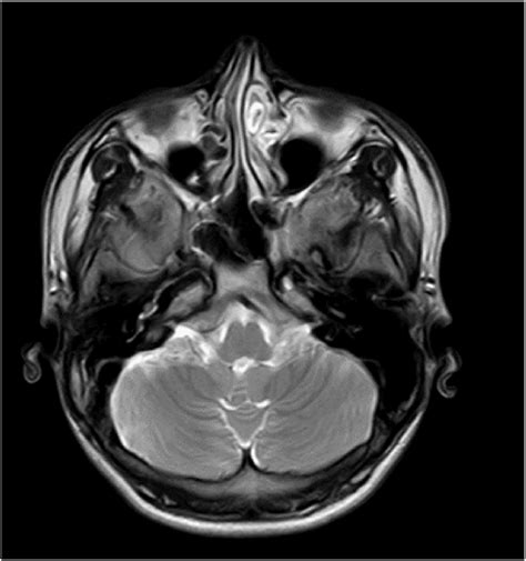 MRI follow up scan of cerebellum showing no altered signal intensity ...