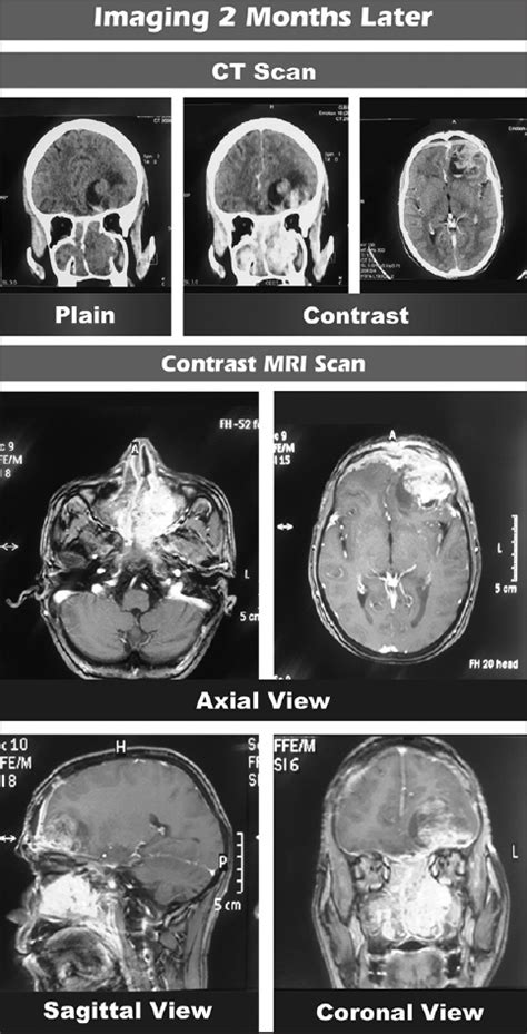 A rare case report of mixed olfactory neuroblastoma: Carcinoma with review of literature ...