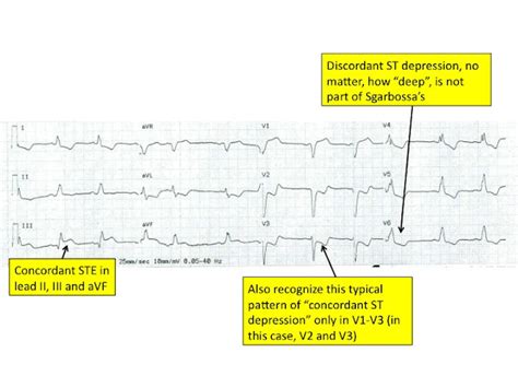 Emergency Medicine Blog: Advanced ECG by Amal Mattu in Singapore