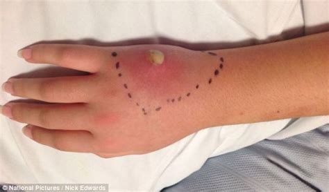 Teenager has chunk of her hand removed after false widow bit her in the CINEMA and left her with ...