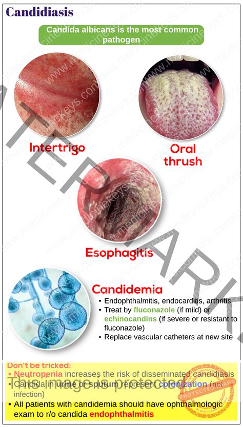 Candidiasis - Medicine Keys for MRCPs