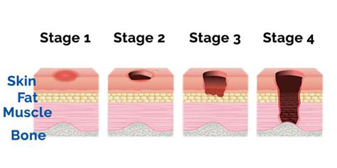 Deep_Tissue_Injury_Stages - Boehringer Labs