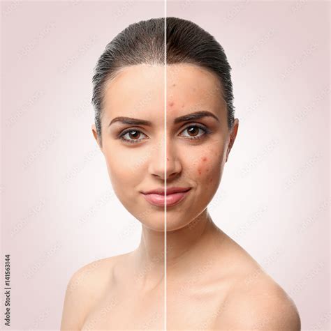 Woman face before and after acne treatment procedure. Skin care concept ...