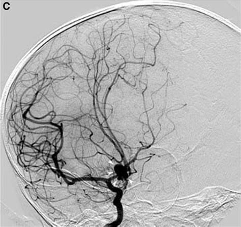 Catheter Angiography