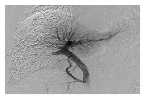 PVE procedure. (a) Direct portogram after portal vein branches were... | Download Scientific Diagram