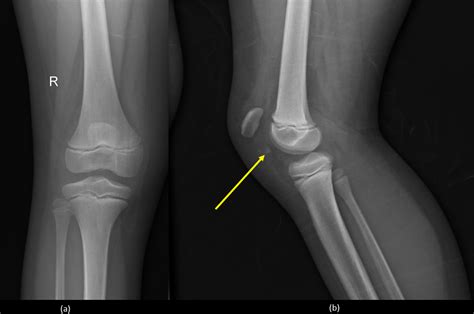 Knee Fracture Plaster Images - Printable Template Calendar