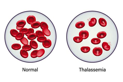 Thalassemia Blood Picture Thalassemia Types Symptoms And Treatment | The Best Porn Website