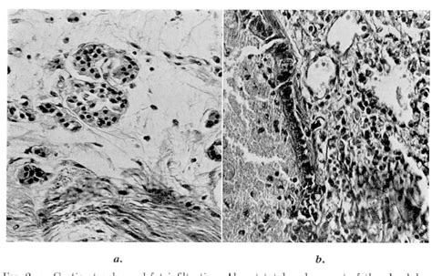 Figure 2 from CYSTIC fibrosis of the pancreas. | Semantic Scholar