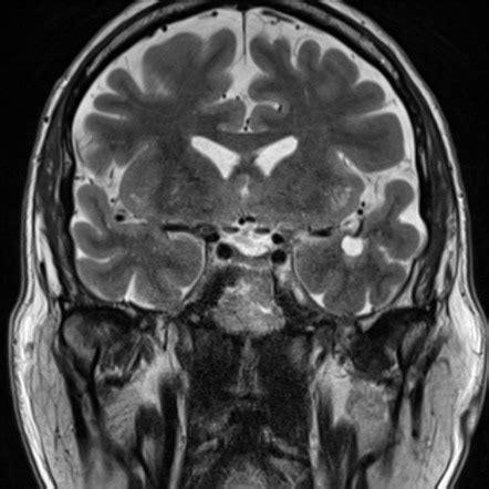 Anterior temporal lobe perivascular spaces | Radiology Reference ...