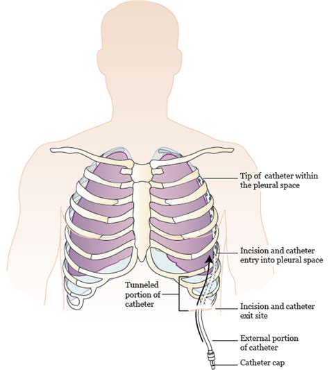 About Your PleurX™ Drainage Catheter | Memorial Sloan Kettering Cancer Center