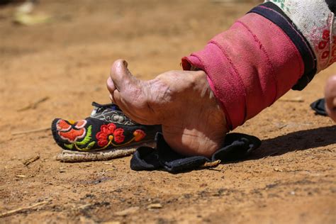 C is for Chinese Foot Binding | Podiatry ABC | Podiatry ABC