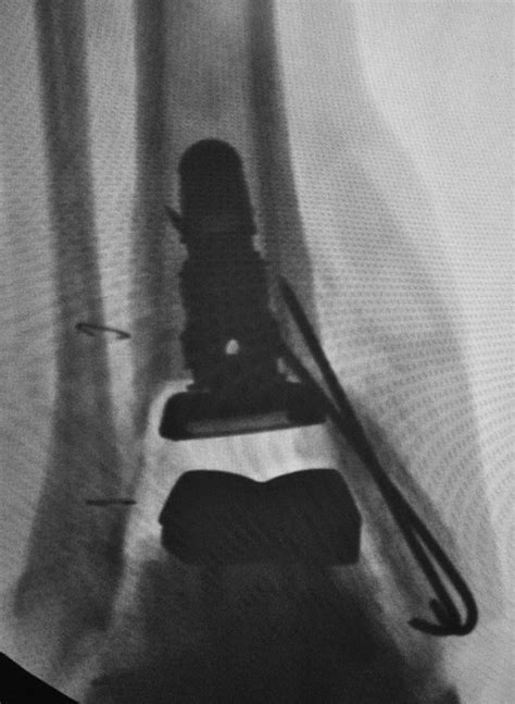 Total Ankle Arthroplasty: Epidemiology and Causes | Musculoskeletal Key