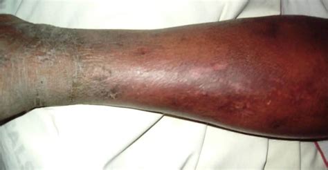 Cellulitis Risk Factors [Causes, and Treatment] - Medical Blog For Students