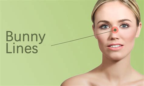 Bunny Lines Fillers Treatment in Surat, Gujarat (India)