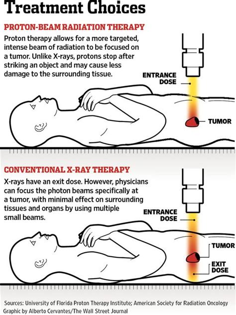 prostate cancer stage - | cancer research in 2018 | Pinterest | Prostate cancer, Cancer and ...