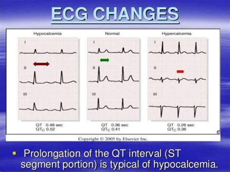 Hypercalcemia and hypocalcemia